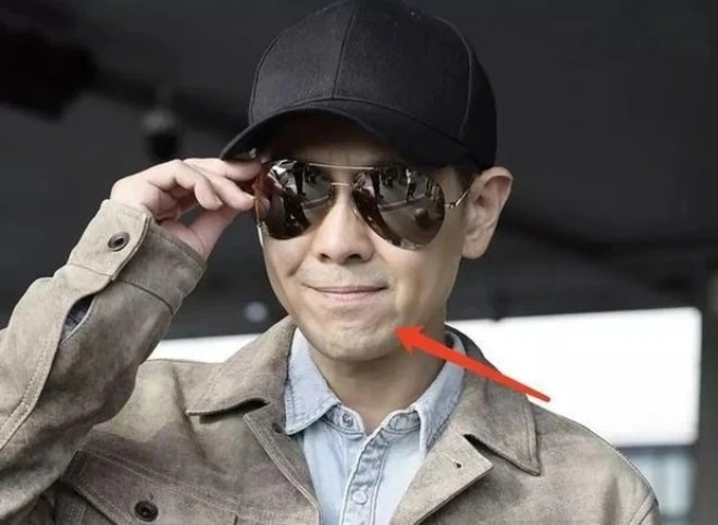 Mặt của anh không còn tự nhiên như xưa vì dấu vết phẫu thuật. 