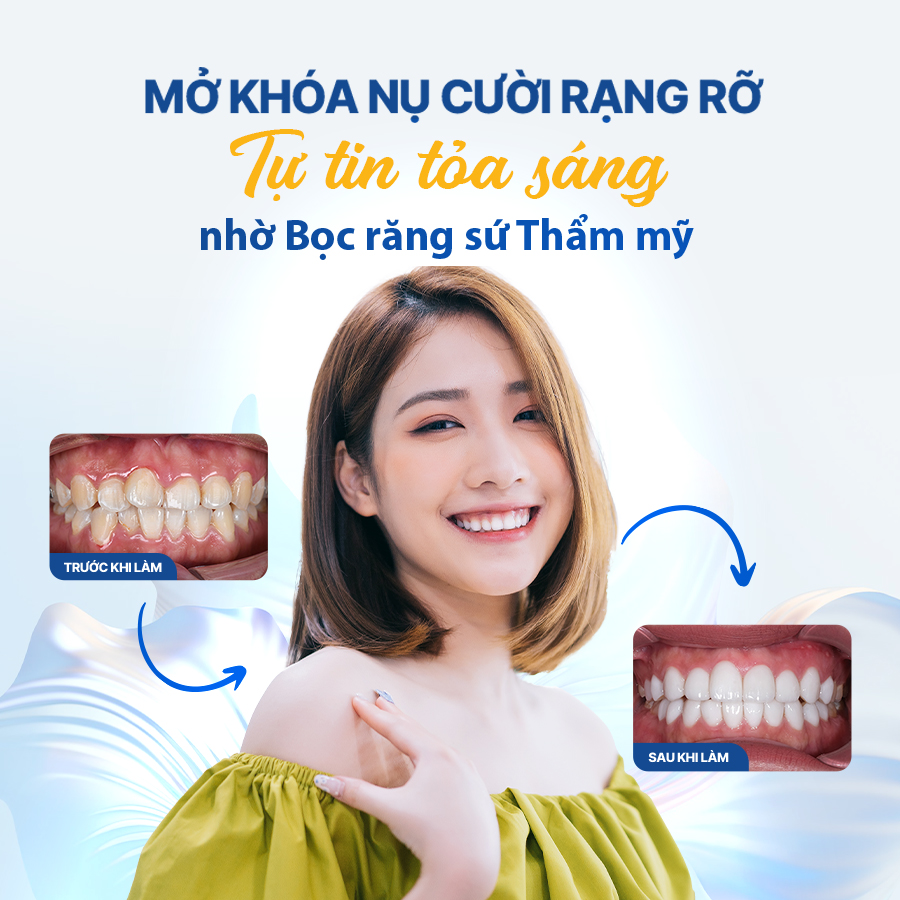 Răng sứ thẩm mỹ Zolid