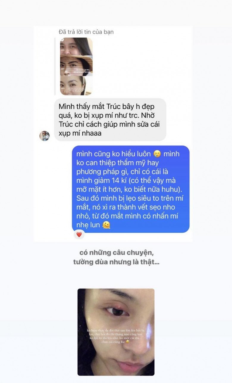 Cô nàng cũng bị đặt câu hỏi là tại sao mĩ mắt lại to, rõ ràng như vậy thì là do sự cố. Người đẹp 9X từng giảm cân nên có thể vì vậy phần mắt gọn hơn. Cô nàng cũng gặp tai nạn là lên lẹo siêu to nên mí mắt bị vết sẹo nhỏ nên từ đó, mắt cô có nhấn mí nhẹ luôn.