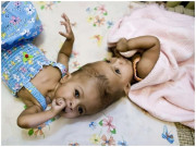 Bà bầu - Cặp song sinh dính liền đầu khiến người mẹ suýt tử vong trên bàn mổ giờ ra sao?