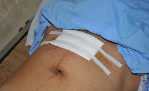 Nếu phát hiện vết mổ bị nhiễm trùng hoặc thấy đau bất thường sau khi xuất viện cần đến bệnh viện kiểm tra càng sớm càng tốt. (Ảnh minh họa)