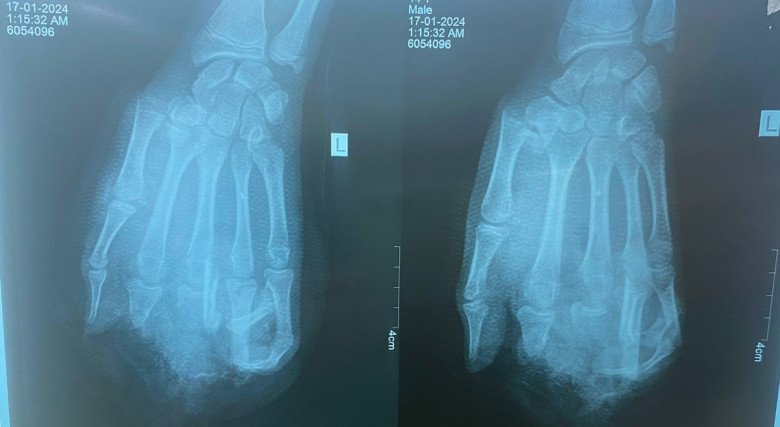 Hình ảnh phim chụp bàn tay nam thiếu niên bị nát do nổ bình gas khi ăn lẩu. Ảnh: BVCC.