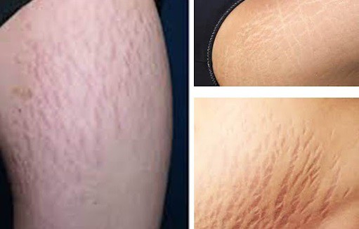 Nhiều trường hợp bị rạn da, mọc ria mép mới biết mình bị biến chứng do sử dụng corticoid. Ảnh minh họa.
