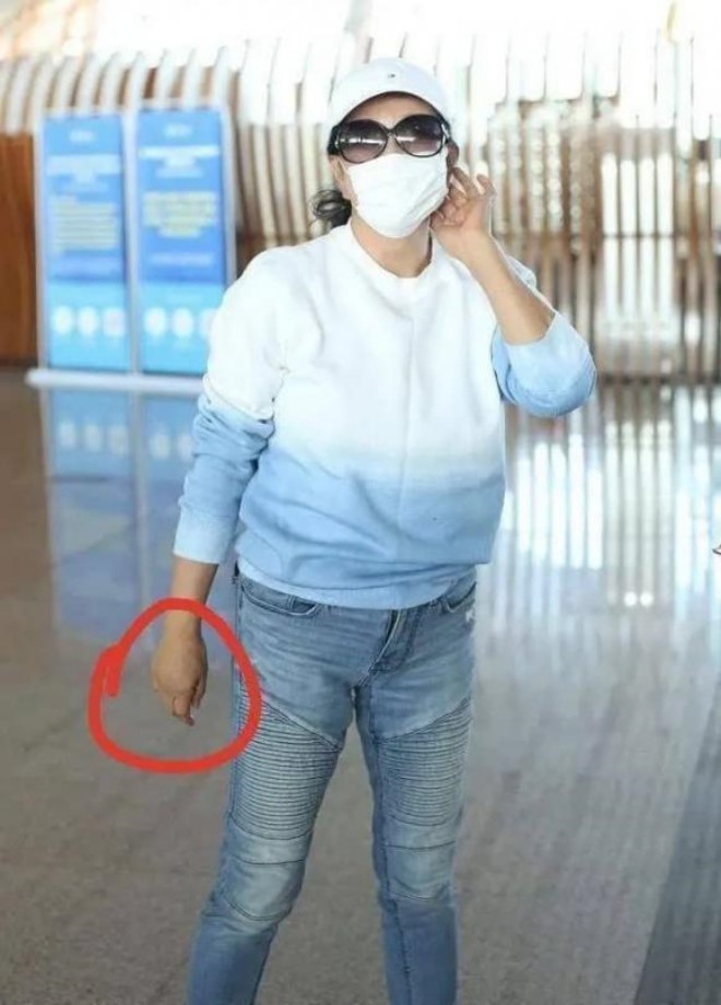 Lưu Hiểu Khánh lộ bàn tay bị sưng phù.