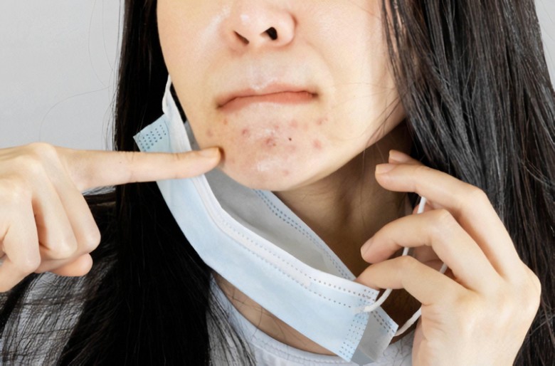 Vì mụn trứng cá, trước đây Giang không dám để lộ mặt thật. .