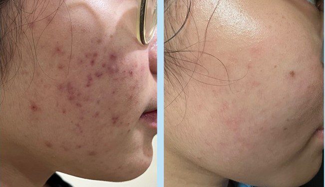 Sau khi điều trị, tình trạng mụn trứng cá của Giang được cải thiện. Ảnh: BVCC.