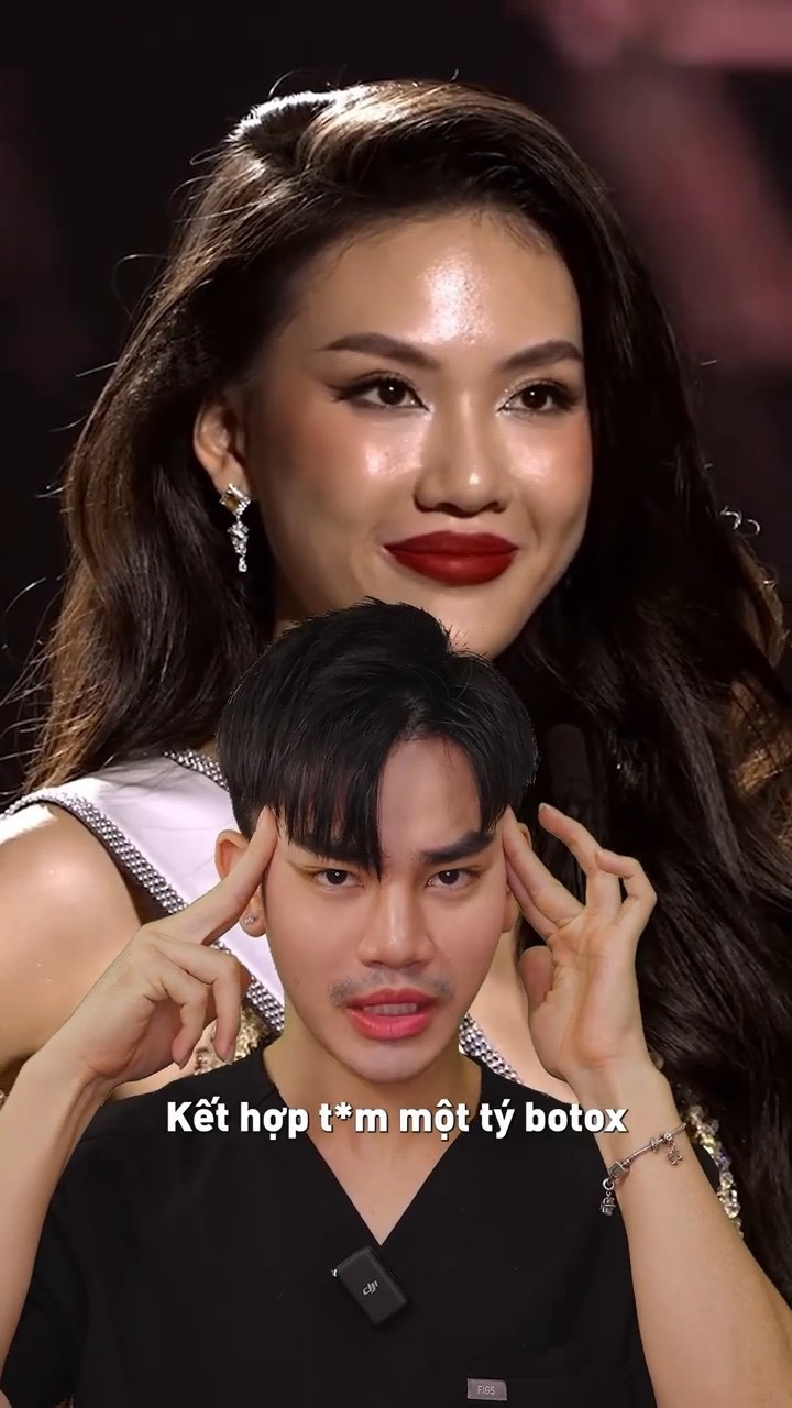 Người này cho rằng Bùi Quỳnh hoa có kết hợp tiêm một tí botox ở phần đuôi mắt. Bên cạnh đó, cô cũng có thể đã tiêm filler môi được căng mọng hơn.