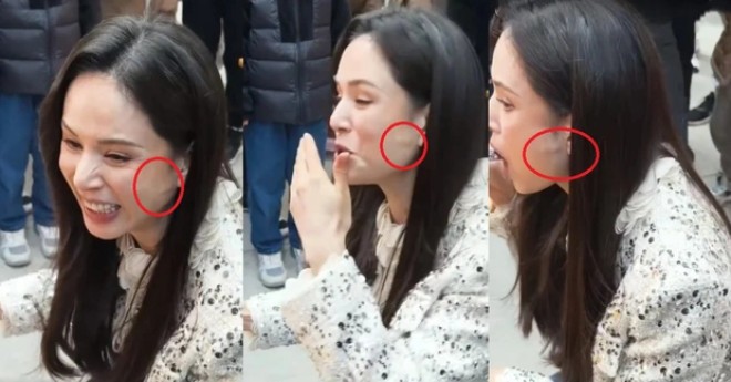 Lý Nhược Đồng có cục u trên mặt. 