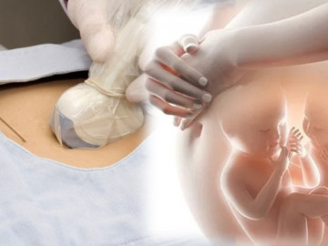 Chọc ối để chẩn đoán bất thường ở thai nhi và những điều mẹ bầu cần biết
