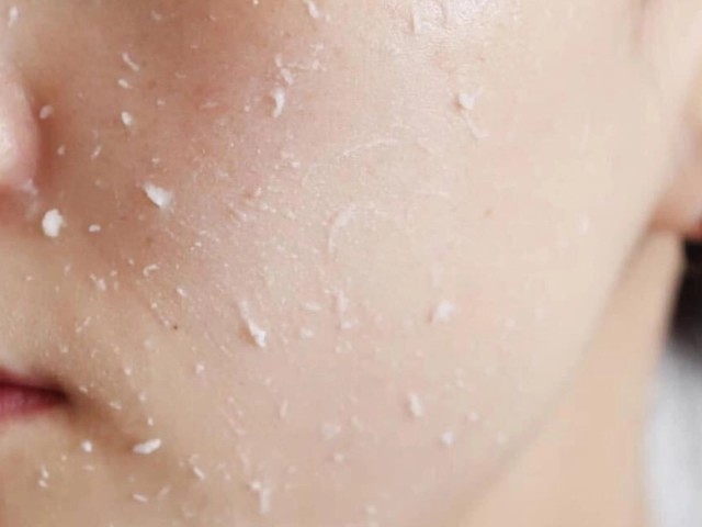 Những tế bào chết này thường không tự rơi mà bám chặt lên bề mặt da, tạo nên lớp bã nhờn và bụi bẩn, làm trở ngại cho quá trình tái tạo tế bào mới.
