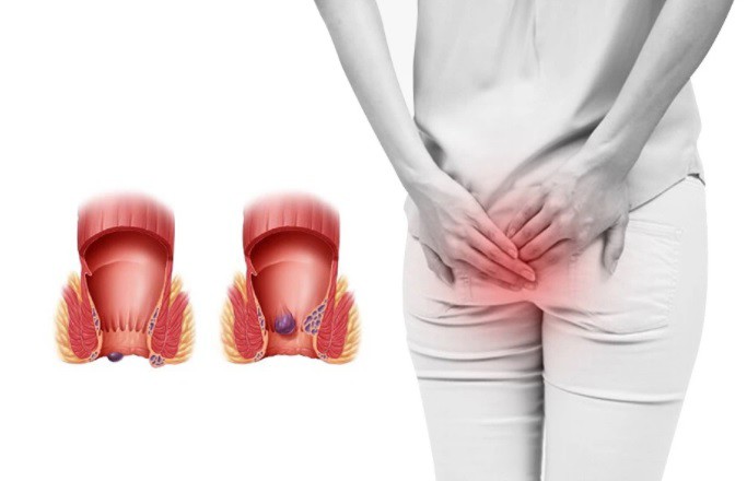 Ngồi hoặc đứng một chỗ quá lâu dễ khiến bà bầu mắc trĩ.