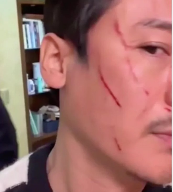 Vương Đông đăng ảnh vết thương trên mặt.