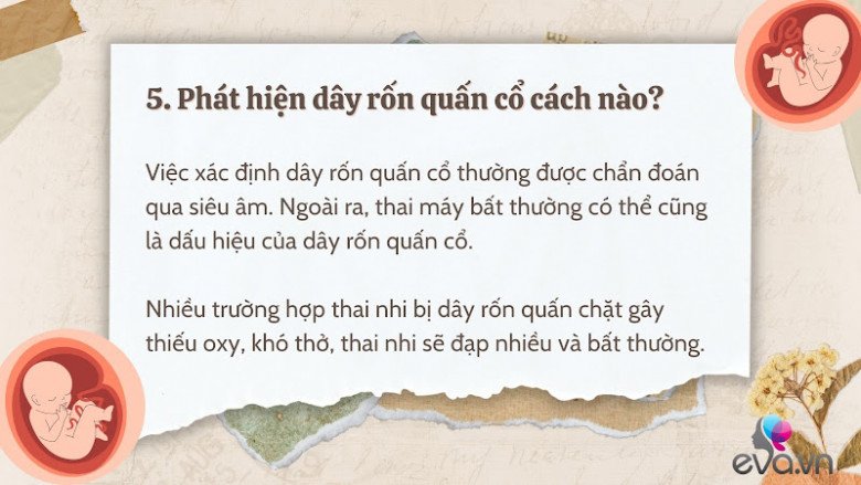 Giải đáp 10 thắc mắc về dây rốn quấn cổ khi mang thai của hầu hết mẹ bầu - 6