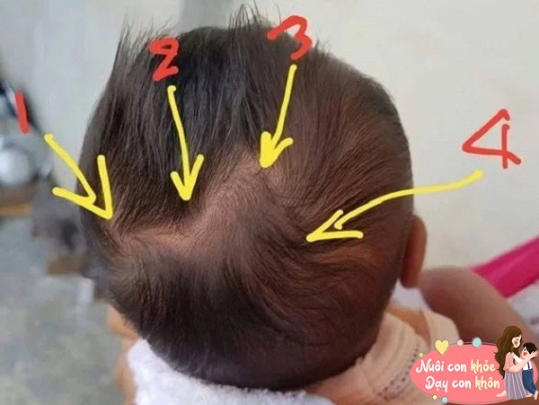 Hiện nay xoáy tóc chưa được dùng làm cơ sở để đánh giá mức độ IQ.