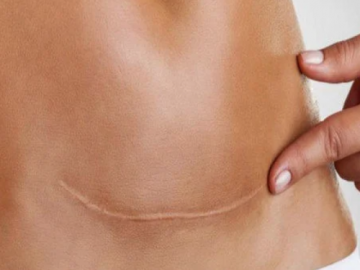 Khuyết sẹo mổ lấy thai có nhất thiết phải mổ?