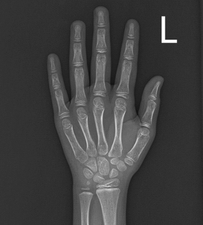 Kết quả chụp X-quang cho thấy tay của bệnh nhi 7 tuổi có tuổi xương tương đương 8 tuổi.