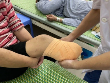 Người phụ nữ bị trẹo chân nhưng chủ quan làm việc này, khi đến viện phải cắt cụt cả hai chân
