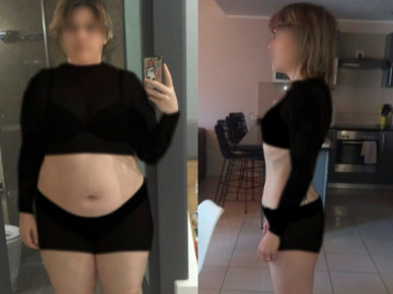 Người phụ nữ giảm 53kg nhờ phẫu thuật thu nhỏ dạ dày, ai nên và ai tránh giảm béo bằng cách này?