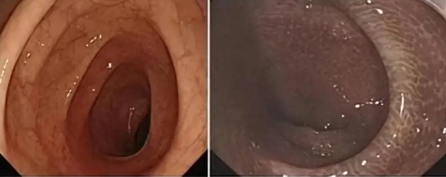 Niêm mạc đại tràng bình thường (bên trái) và khi bị bệnh hắc tố đại tràng (bên phải).