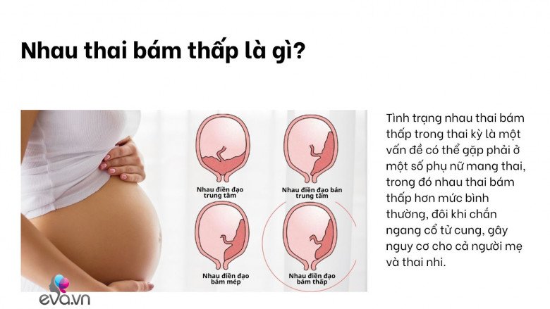 Nhau thai bám thấp: Tình trạng mẹ bầu nào cũng sợ và các nguy hiểm cần biết - 1