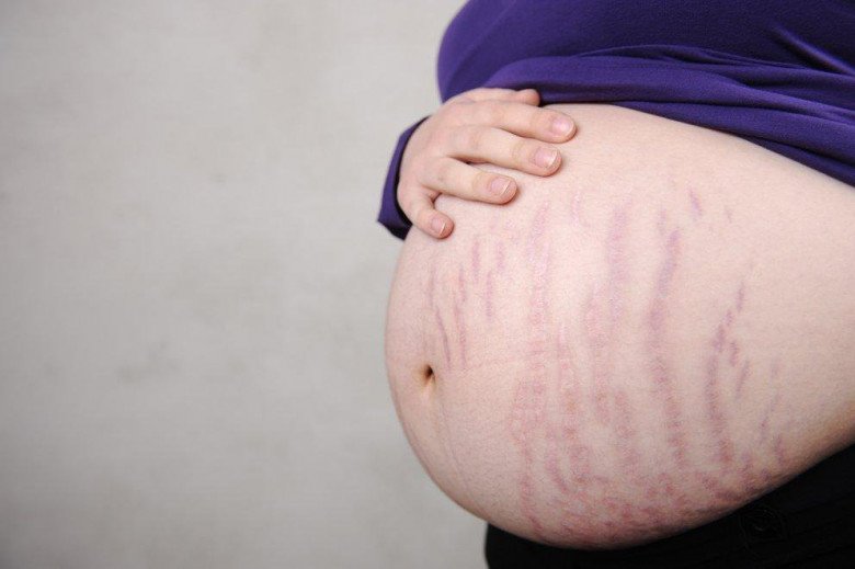 Việc tăng cân nhanh, số đo cơ thể thay đổi đột ngột cũng gây ra tình trạng rạn da ở phụ nữ có thai.