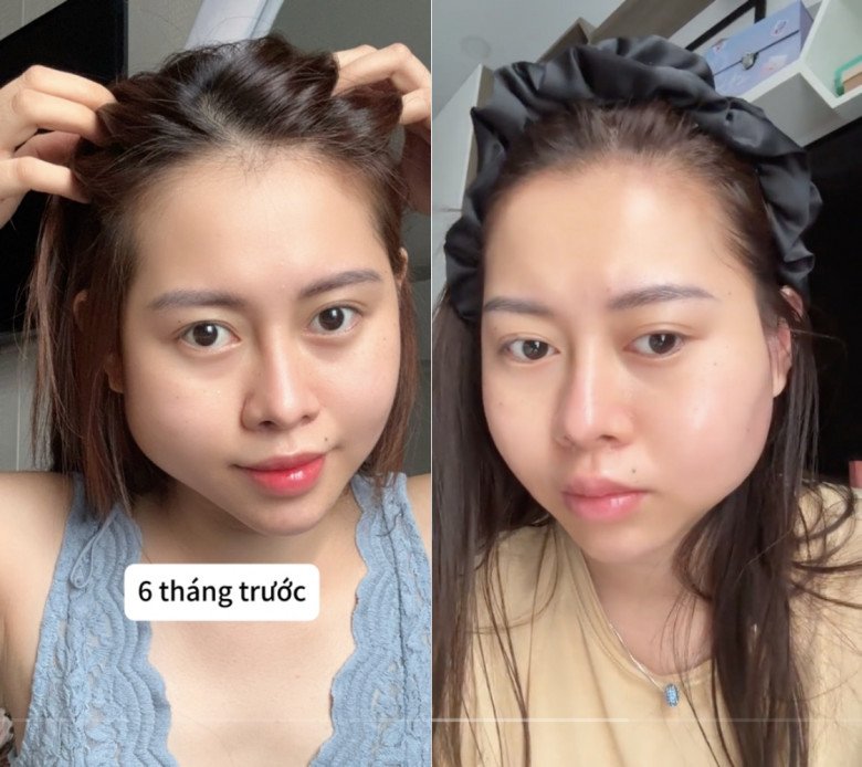 Cô nàng bị viêm má bên phải trước và sau đó là má đối diện.