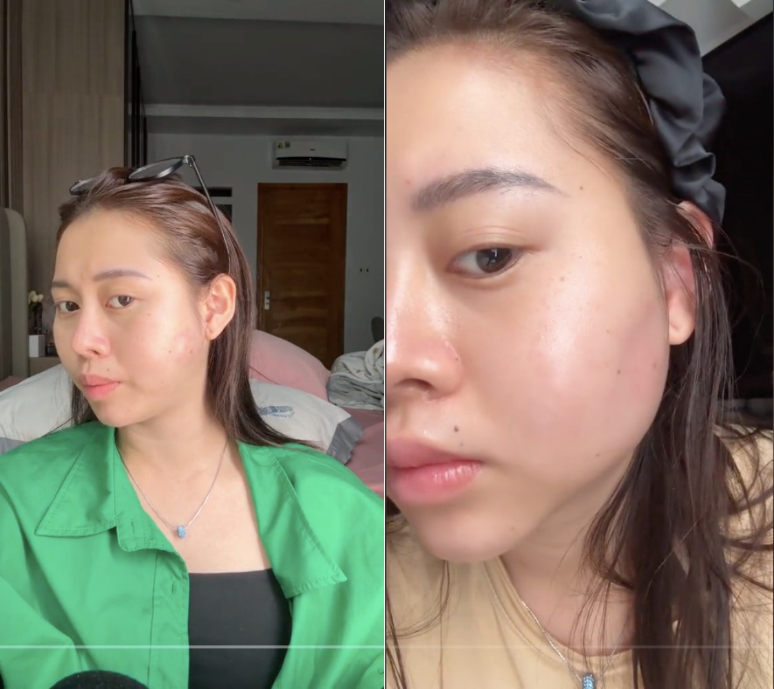 Filler hay silicon việc thăm khám rất khó phát hiện, nếu như không gặp biến chứng.