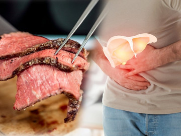Gan nhiễm mỡ không nên ăn gì? Những thực phẩm càng ăn càng khiến gan nhanh xơ như mướp