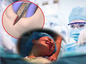 Có bao nhiêu mẹ ở đây hiểu đúng về RẠCH và KHÂU tầng sinh môn khi sinh thường?