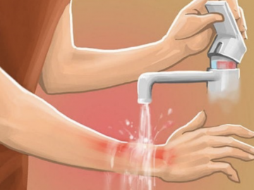 Ngâm con trong thùng nước lạnh để chữa bỏng gây sốc nhiệt