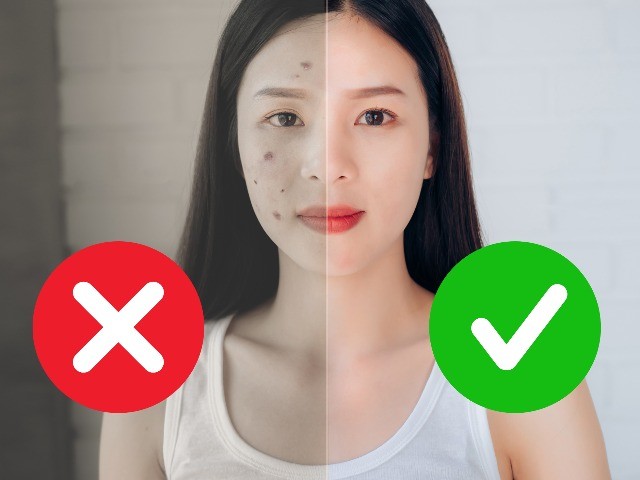 Bác sĩ da liễu Hàn Quốc chỉ ra 3 bước giúp chị em giải quyết triệt để mụn bọc tại nhà