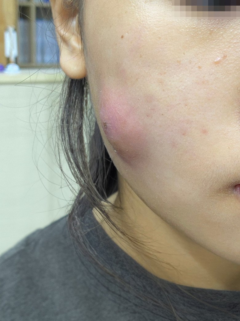 Cô gái trẻ phải nhận trái đắng vì muốn tân trang lại khuôn mặt để đỡ bị chê. Ảnh: BSCC.