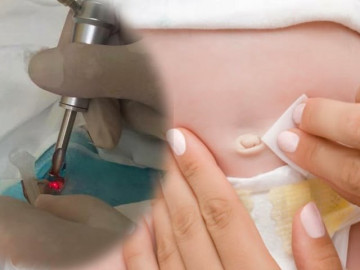  Cắt rốn bằng laser có lợi cho trẻ thế nào   và những điều mẹ bầu cần biết về phương pháp hiện đại này