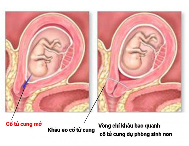 Khâu eo cổ tử cung là giải pháp mang tính cơ học và tốt nhất, giúp sản phụ giữ thai.