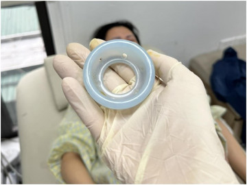 Mẹ bầu nên khâu cổ tử cung hay đặt vòng nâng Arabin để dự phòng sinh non? 