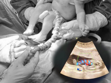 Thấy hình ảnh siêu âm bất thường của thai phụ 20 tuổi, bác sĩ chỉ định mổ lấy thai khẩn cấp