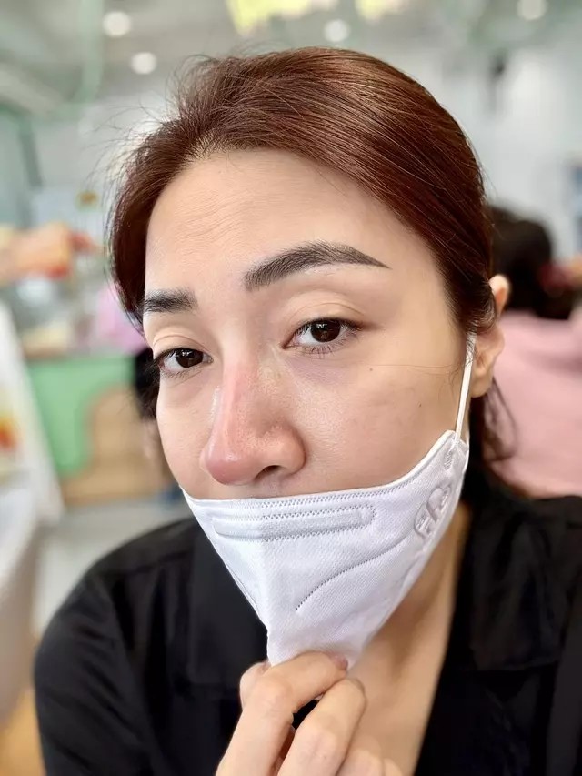Hiện tại, ca sĩ Pha Lê đã phải tháo sụn mũi để làm sạch chỗ bị viêm và cũng bớt đau nhức hơn. Vì chăm con nên cô cũng lựa chọn cách gây tê thay vì gây mê. 