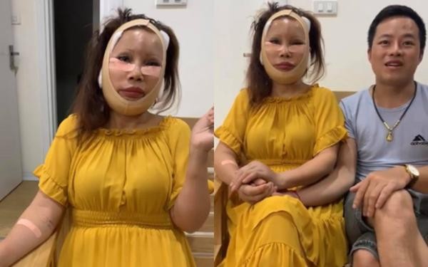Gương mặt biến dạng sau phẫu thuật của Thu Sao từng khiến nhiều người lo lắng.