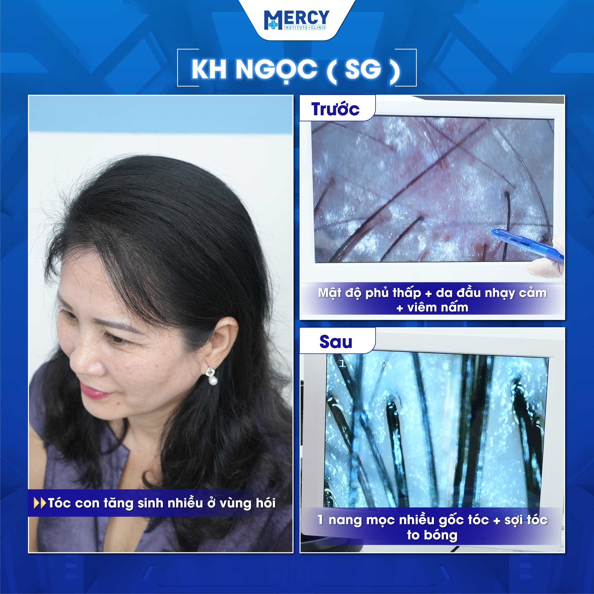 Phòng khám Mercy tiên phong xu hướng điều trị rụng tóc hói đầu 2024 - 4