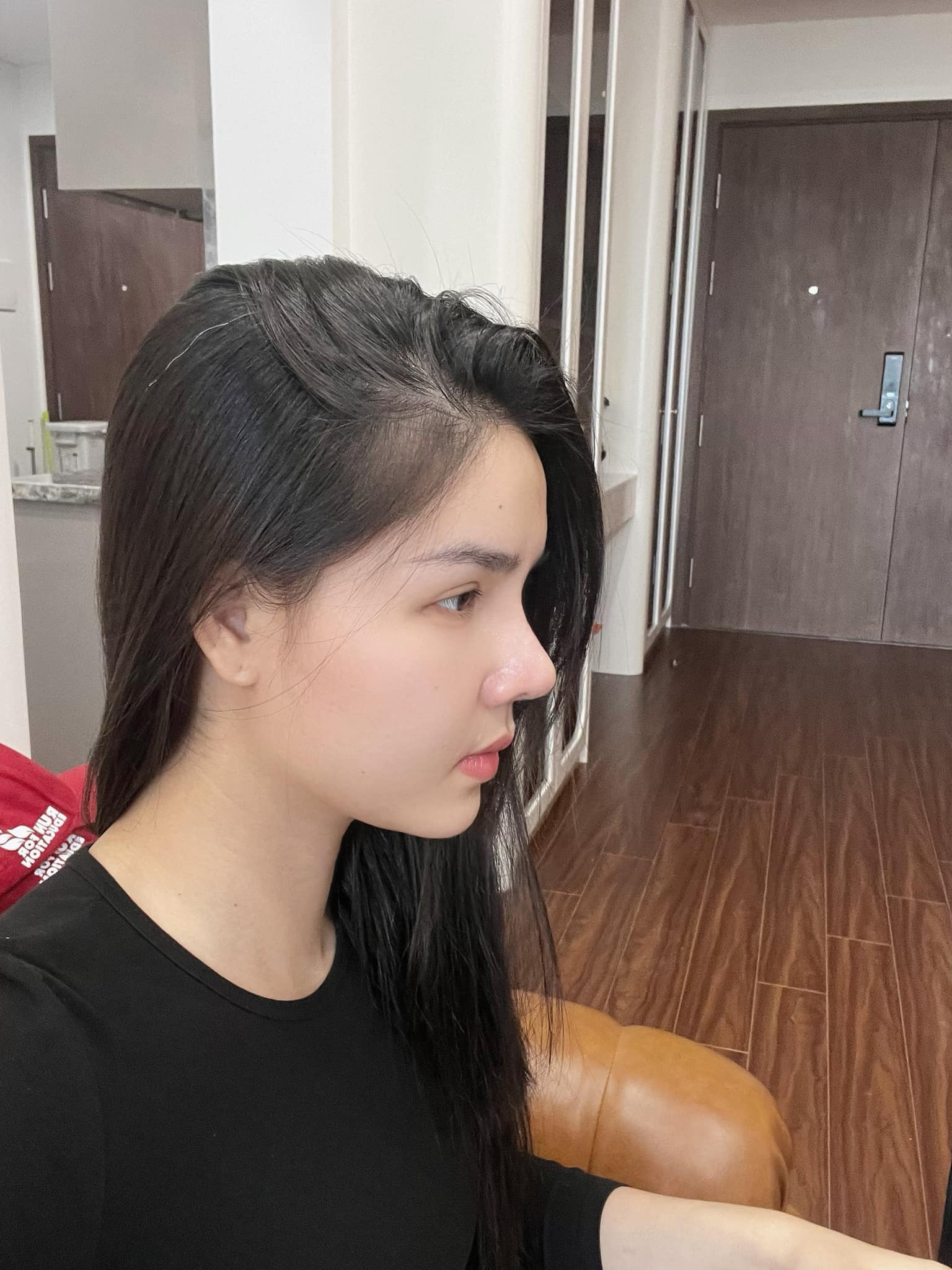 Kỳ Hân chia sẻ hình ảnh chiếc mũi sau 15 ngày làm lại.