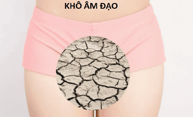 Sự sụt giảm estrogen gây khô âm đạo ở phụ nữ sau mãn kinh. Ảnh minh họa.