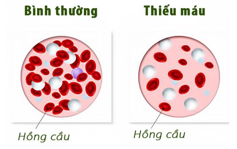 Thiếu máu là nguyên nhân gây lạnh tay chân.