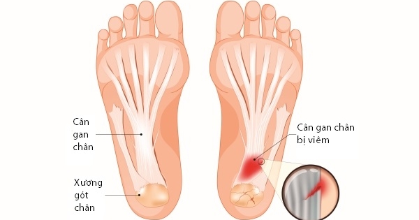 Đi bộ quá nhiều có thể dễ dàng dẫn đến viêm cân gan chân.