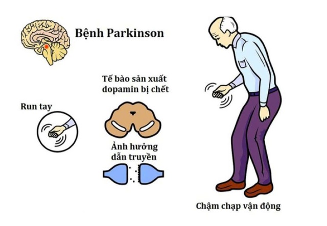 Bệnh Parkinson chủ yếu ảnh hưởng đến các tế bào thần kinh sản xuất dopamine.