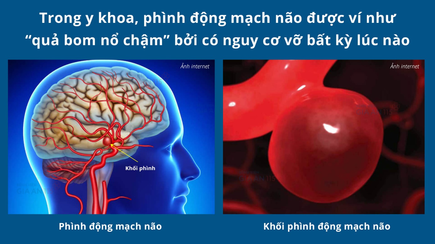 Chứng phình động mạch não.