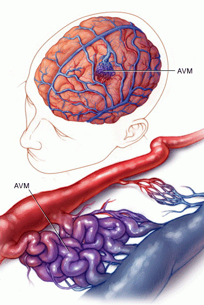 AVM biến dạng mạch máu não.