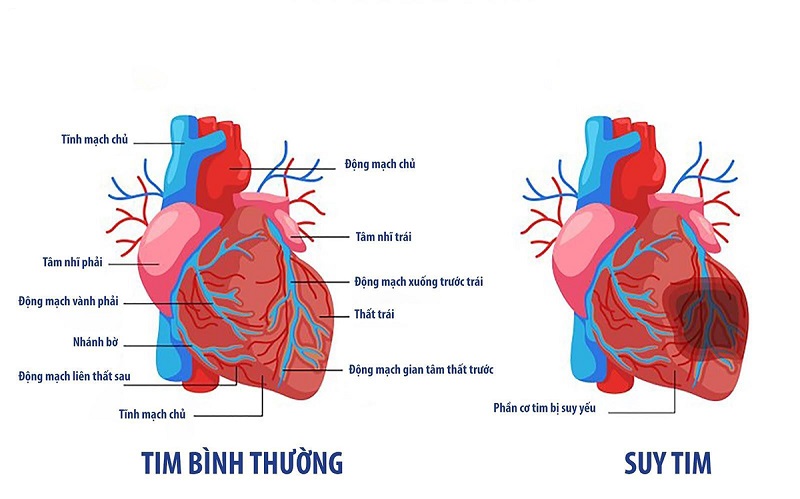 Cứ sau 1,5 giờ không hoạt động hàng ngày, nguy cơ suy tim tăng 17%.