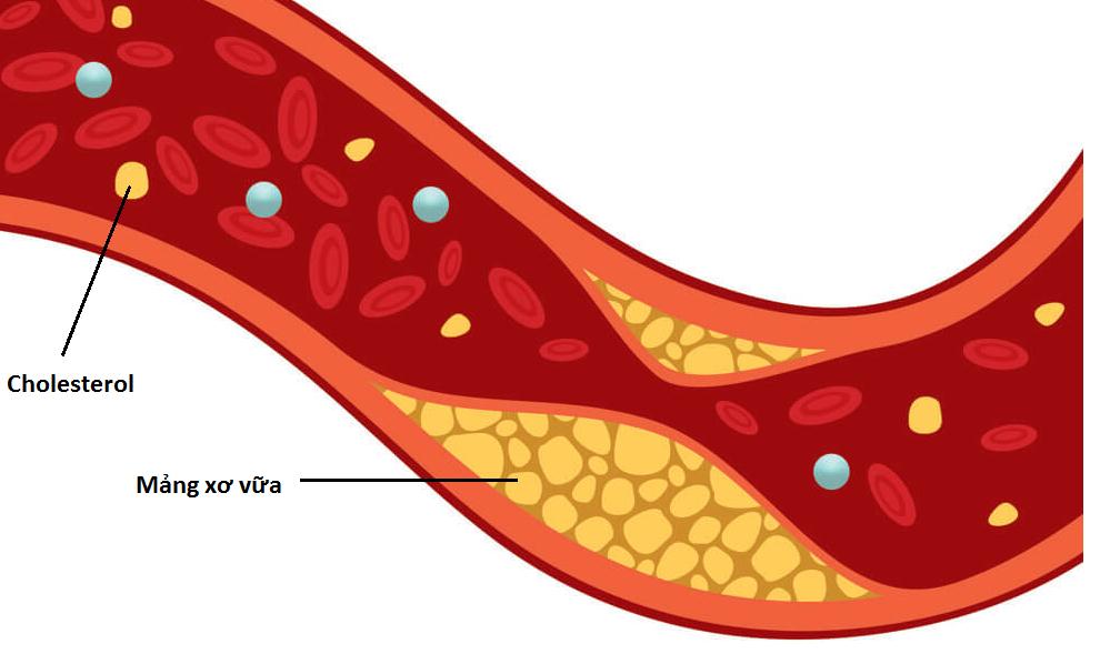 Cholesterol xấu có thể gây xơ vữa động mạch và các vấn đề liên quan.