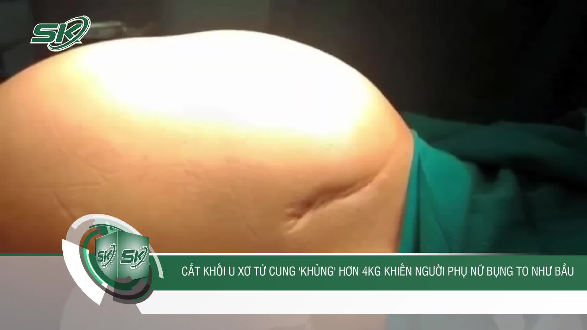 Cắt khối u xơ tử cung khủng hơn 4kg khiến người phụ nữ bụng to như mang bầu