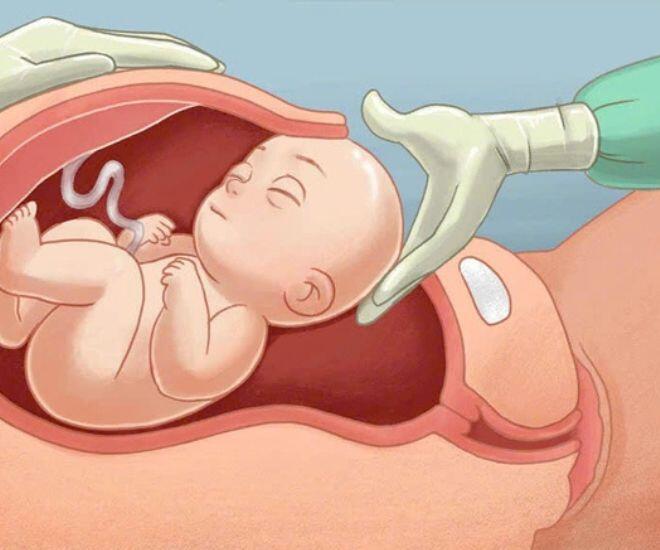 Sinh mổ không theo kế hoạch có thể ảnh hưởng đến sức khỏe tinh thần của người mẹ.